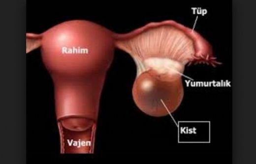 Sol Yumurtalk Kisti