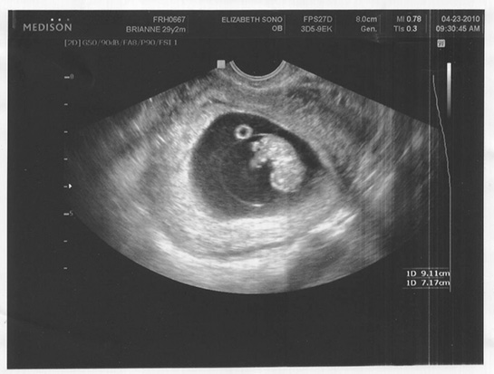 Hamilelikte Yumurtalık Kisti