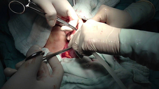 Yumurtalık Ameliyatı Riskleri ve Sonrası