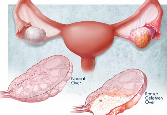 Yumurtalık Belirtileri ve Tedavisi
